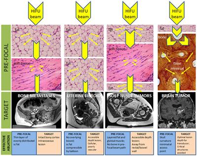 Tissue specific considerations in implementing high intensity focussed ultrasound under magnetic resonance imaging guidance